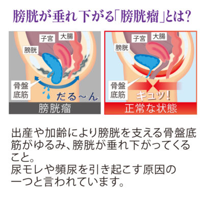 [一般医療機器]　サラッと快適 モレナレディショーツ